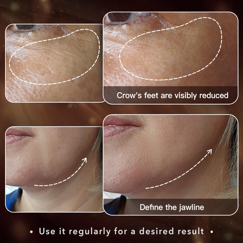 Radio Frequency Skin Tightening | Professional 25 Watts RF Facial | 50 Watts RF Body | Tightening | Lifting | Wrinkle Reduce - Increase Collagen - Home RF Anti Aging Beauty Machine - Salon Effects